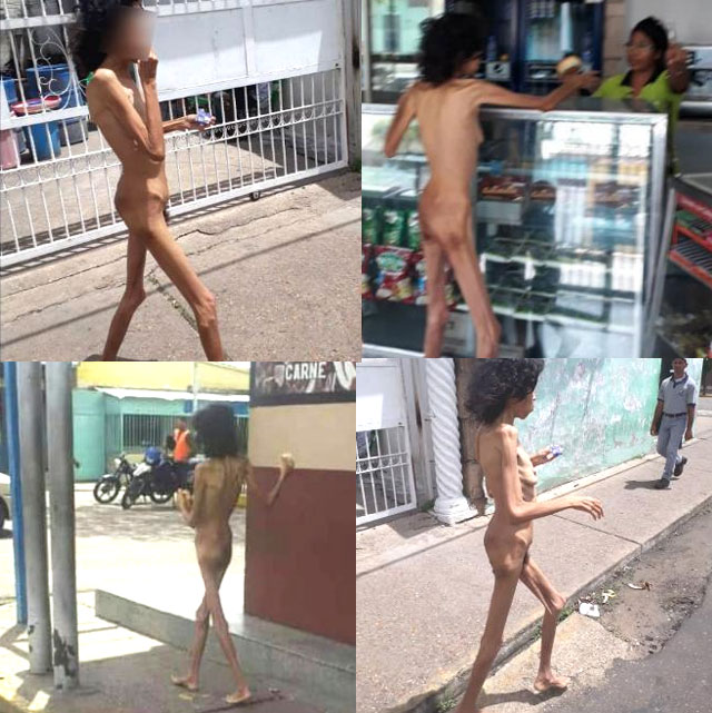 Impactantes imgenes: venezolana desnuda y desnutrida deambula por las calles de Cantaura. Parece una mujer salida de un campo de concentracin. cubademocraciayvida.org web/folder.asp?folderID=136   